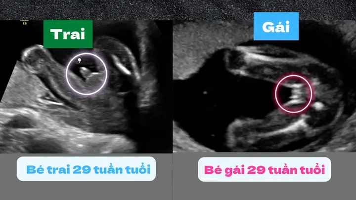 Bao Nhiêu Tuần Siêu Âm Biết Trai Hay Gái