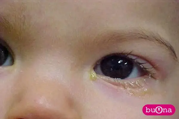 Bé Bị Gỉ Mắt Màu Xanh: Nguyên Nhân, Cách Xử Lý Và Khi Nào Cần Đến Bác Sĩ