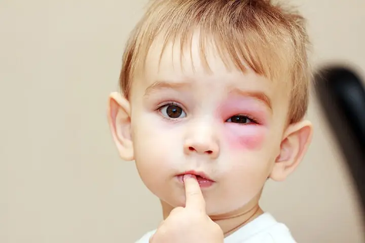 Bé Bị Nổi Mụn Quanh Mắt: Nguyên Nhân, Cách Xử Lý An Toàn Và Khi Nào Cần Đi Khám