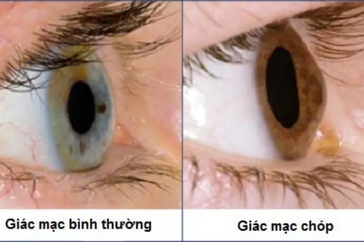 Bệnh Giác Mạc Hình Chóp Là Gì? Nguyên Nhân, Triệu Chứng & Cách Điều Trị
