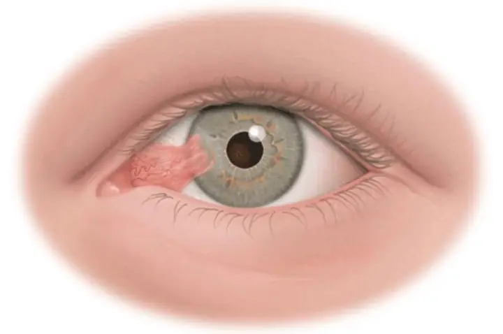 Bệnh Mộng Thịt Ở Mắt: Tổng Từ Nguyên Nhân Đến Cách Điều Trị