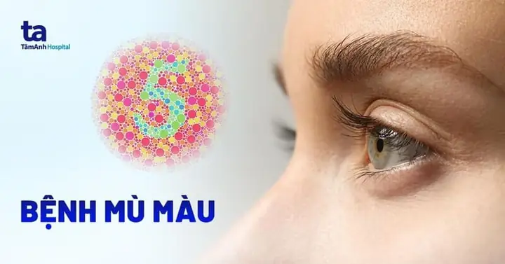 Bệnh Mù Màu Là Gì? - Tổng Quan Về Đột Biến Gen Và Cách Quản Lý