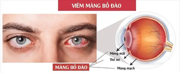 Viêm Màng Bồ Đào: Tổng Quan Về Nguyên Nhân, Triệu Chứng Và Điều Trị