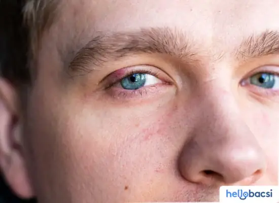 Cách Điều Trị Chắp Mắt Tại Nhà: Từ Nhận Biết Đến Phòng Ngừa Hiệu Quả
