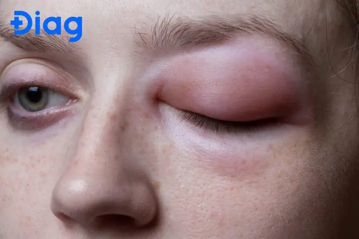 Dị Ứng Sưng Mặt: Cách Xử Lý Tại Nhà Và Khi Nào Cần Cấp Cứu