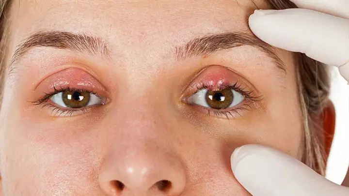 Lẹo Mắt Có Mủ: Nguyên Nhân Và Cách Xử Lý Tại Nhà