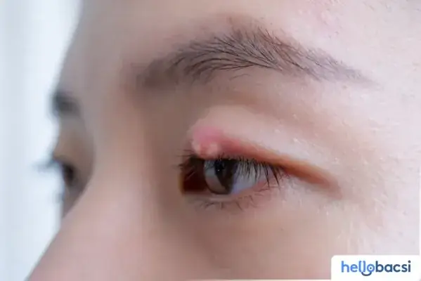 Lẹo Mắt Kiêng Ăn Gì Và Những Điều Cần Tránh Để Bệnh Nhanh Khỏi