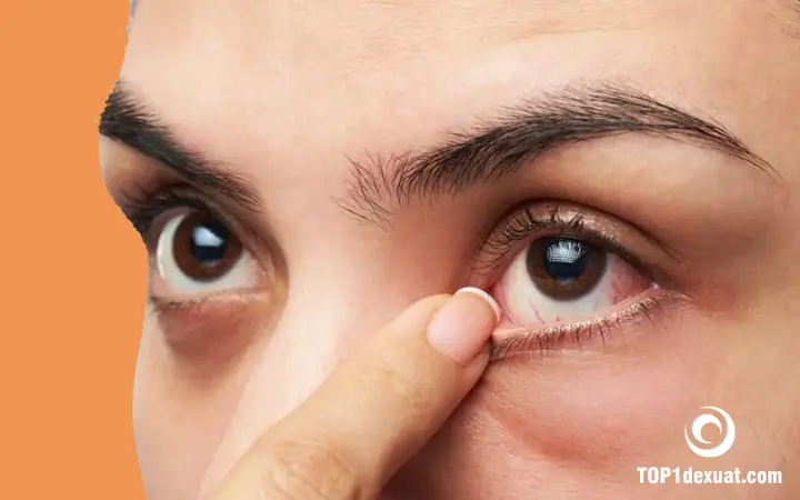 Lẹo Mắt Là Gì? Hướng Dẫn Toàn Tập Về Nguyên Nhân, Triệu Chứng Và Cách Chữa Trị Hiệu Quả