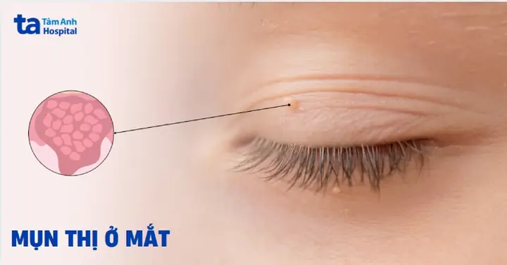 Bị Mụn Thịt Ở Mắt Là Gì? Nguyên Nhân, Cách Xử Lý An Toàn