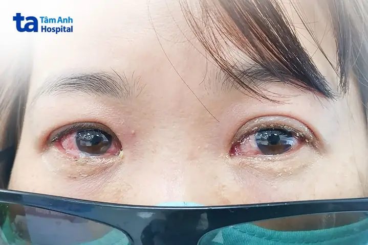 Bị Nhậm Mắt Làm Sao Hết? Hướng Dẫn Chi Tiết Từ Chuyên Gia