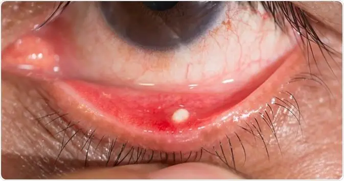 Bị Sạn Vôi Trong Mắt: Cách Xử Lý Nhanh Chóng Và An Toàn