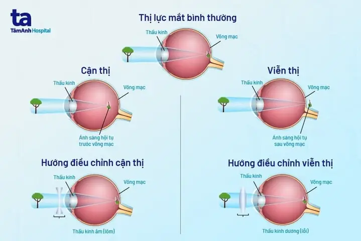 Biểu Hiện Của Tật Khúc Xạ Là Gì? Các Dạng Phổ Biến & Cách Nhận Biết