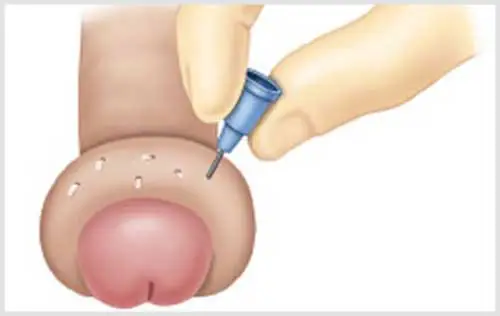 Bọng Nước Ở Bao Quy Đầu: Nguyên Nhân & Cách Xử Lý An Toàn