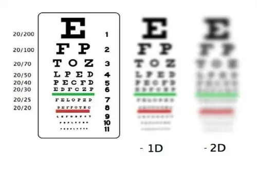 Các Mức Độ Cận Thị Là Gì? Phân Loại Chi Tiết Theo Tiêu Chuẩn Y Học