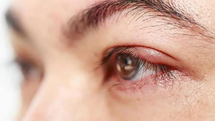 Cách Chữa Lẹo Mắt Tại Nhà: 7 Phương Pháp Hiệu Quả Và An Toàn