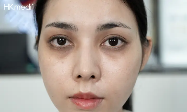 Cách Chữa Thâm Quầng Mắt Bẩm Sinh Hiệu Quả