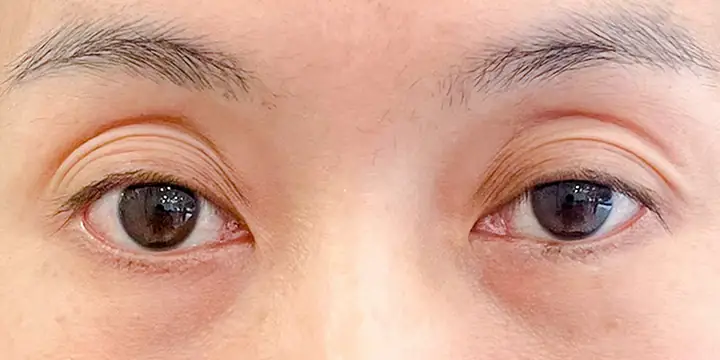Cách Làm Đầy Hốc Mắt Tự Nhiên: 6 Phương Pháp Đơn Giản Hiệu Quả