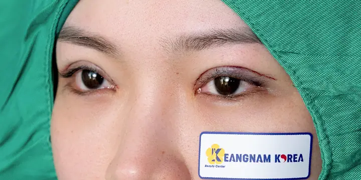 Cách Làm Mắt Hết Sưng Khi Phun Mí