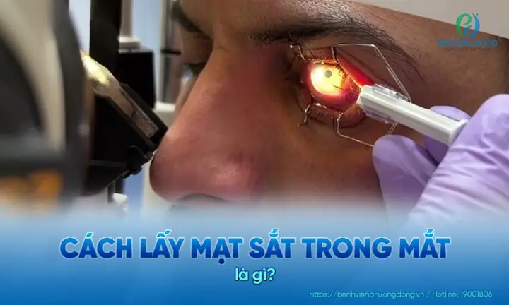 Cách Lấy Mạt Sắt Trong Mắt An Toàn: Hướng Dẫn Chi Tiết Từ Chuyên Gia