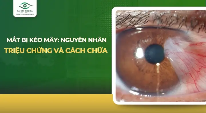 Cách Trị Mắt Bị Kéo Mây: Nguyên Nhân & Biện Pháp Khắc Phục