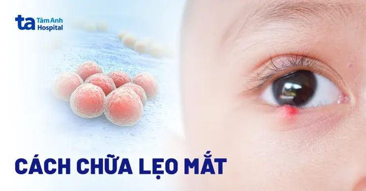 Cách Vệ Sinh Mắt Khi Bị Lẹo Đúng Cách, An Toàn