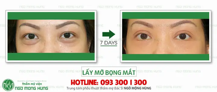 Cách Xóa Bọng Mỡ Mắt: Tổng Hợp Phương Pháp Tự Nhiên & Phẫu Thuật