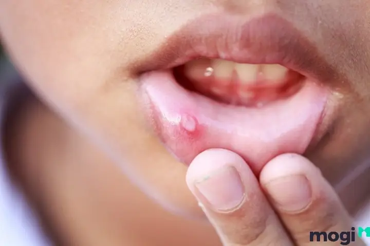 Cắn Vào Môi Là Điềm Gì? Giải Thích Chi Tiết Từ Y Học Đến Tâm Linh
