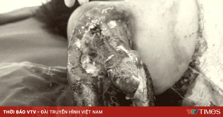 Điện Giật: Từ Triệu Chứng Đến Biến Chứng Nặng Và Cách Xử Lý An Toàn