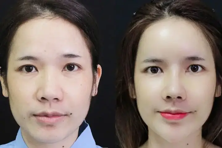 Cắt Cánh Mũi Có Mất Lộc Không? Phân Tích Toàn Diện Từ A Đến Z