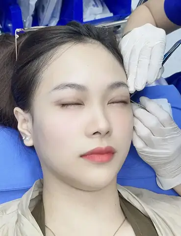 Cắt Chỉ Mí Mắt Sau Bao Lâu? Hướng Dẫn Chi Tiết Từ A Đến Z