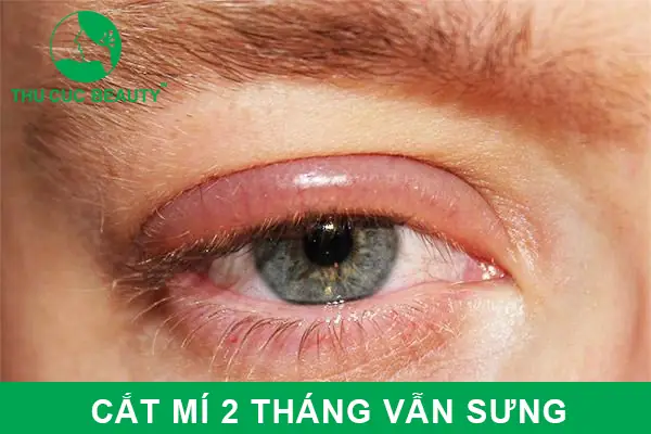 Cắt Mí 2 Tháng Vẫn Sưng: Nguyên Nhân Và Cách Xử Lý Hiệu Quả