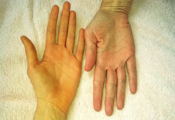 Da Đột Ngột Bị Vàng: Nguyên Nhân, Dấu Hiệu Và Cách Xử Lý Hiệu Quả
