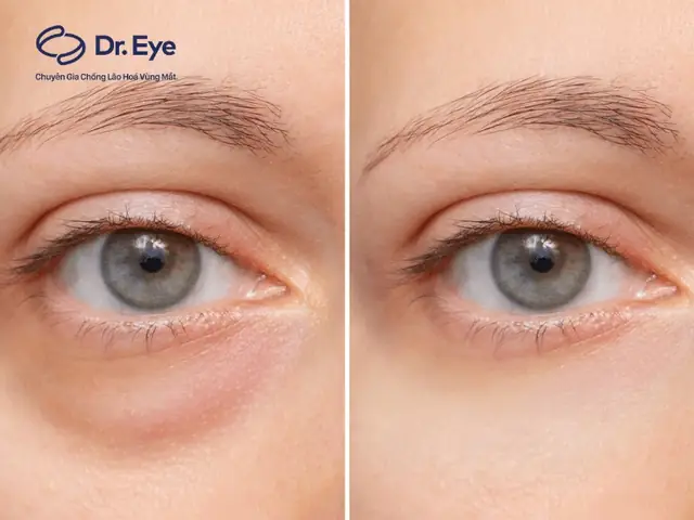 Dầu Dừa Trị Bọng Mắt: Công Dụng Thực Tế Và Cách Áp Dụng