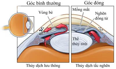 Dấu Hiệu Bị Cườm Mắt Cần Cấp Cứu Ngay