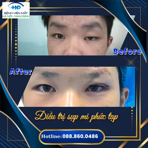 Sụp Mí Mắt: Nguyên Nhân, Dấu Hiệu Nhận Biết Và Cách Điều Trị Hiệu Quả