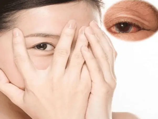 Đau Mắt Đỏ Cần Kiêng Gì? Danh Sách Đầy Đủ & Lưu Ý Quan Trọng