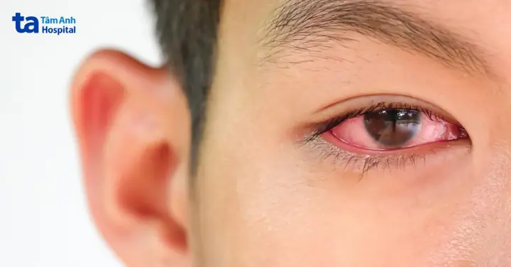 Đeo Lens Bị Đỏ Mắt: Nguyên Nhân Và Cách Khắc Phục Hiệu Quả