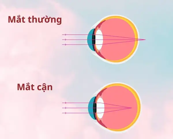 Độ Trục Mắt Là Gì? Giải Thích Chi Tiết Và Ứng Dụng Thực Tế