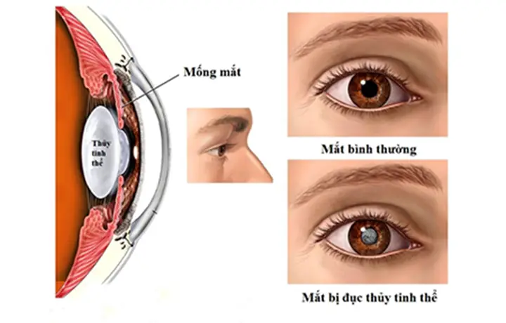 Đục Thủy Tinh Thể: Nguyên Nhân, Triệu Chứng Và Cách Điều Trị Toàn Diện