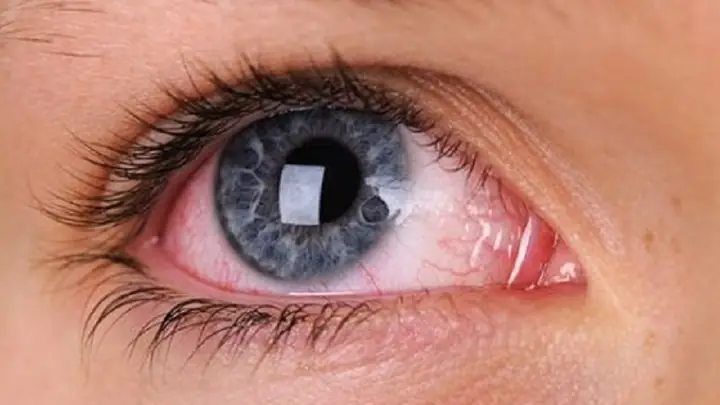 Dụi Mắt Bị Sưng Tròng Trắng: Nguyên Nhân & Cách Xử Lý Hiệu Quả