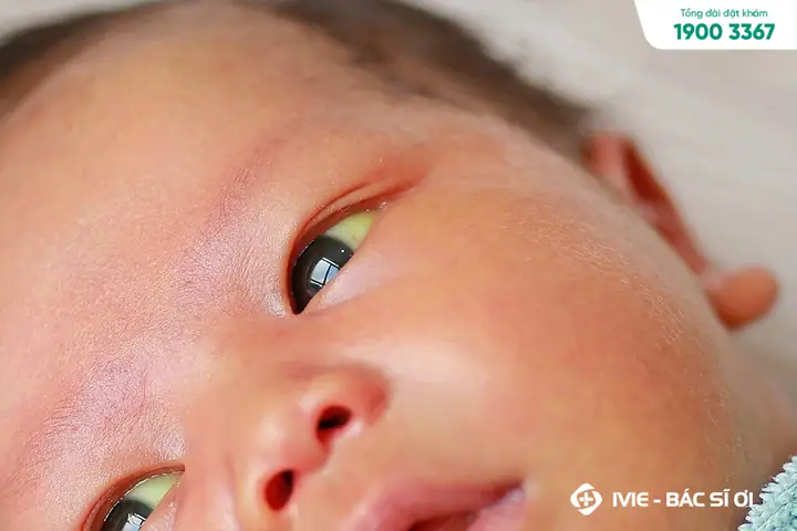 Em Bé Sơ Sinh Bị Vàng Mắt: Nguyên Nhân, Cách Xử Lý Và Khi Nào Cần Đến Bác Sĩ