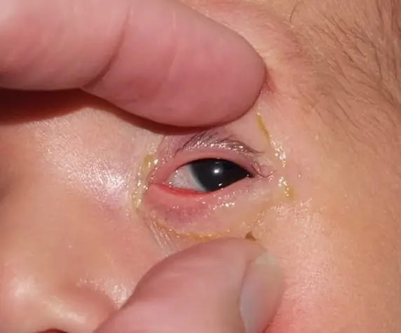 Ghèn Mắt Ở Trẻ Sơ Sinh: Nguyên Nhân Và Cách Xử Lý