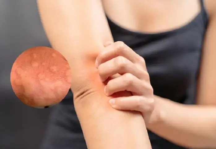Tại Sao Hay Bị Ngứa Về Đêm? Nguyên Nhân Và Cách Xử Lý Chi Tiết