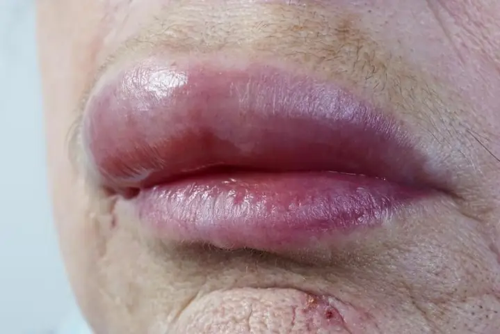 Hay Bị Sưng Môi Trên: Nguyên Nhân Phổ Biến Và Cách Khắc Phục