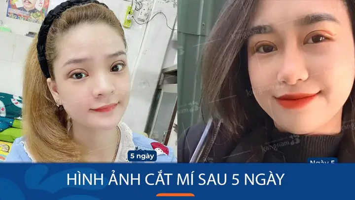 Hình Ảnh Cắt Mí Sau 5 Ngày: Diễn Biến Thực Tế Và Hướng Dẫn Chăm Sóc