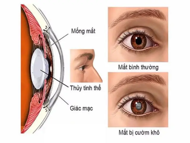 Hình Ảnh Mắt Bị Cườm Nước Là Gì? Nguyên Nhân & Cách Xử Lý