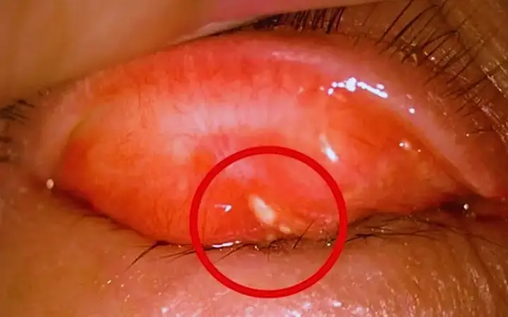 Sạn Vôi Ở Mắt Là Gì? Nguyên Nhân & Cách Xử Lý Hiệu Quả