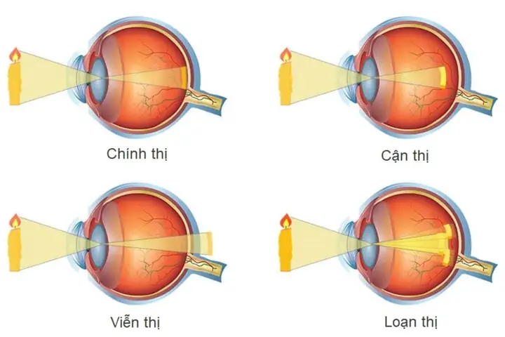 Hình Ảnh Tật Khúc Xạ: Các Loại, Đặc Điểm Nhận Biết Và Ý Nghĩa