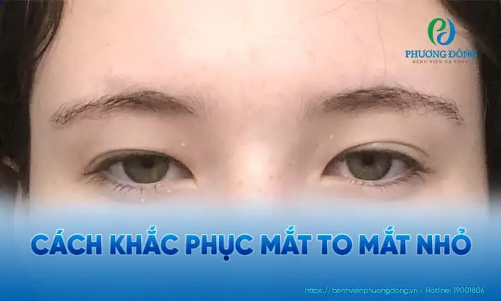 Khắc Phục Mắt To Mắt Nhỏ Tại Nhà