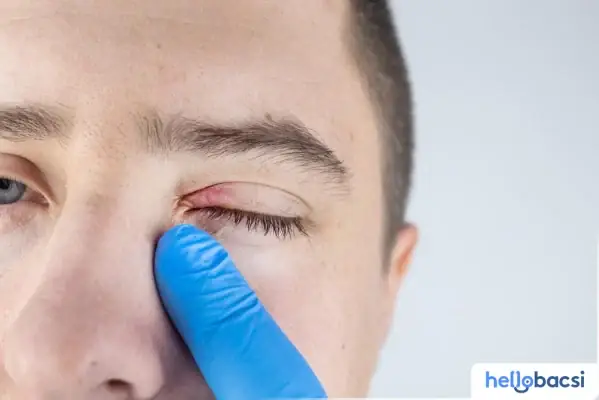 Kháng Sinh Điều Trị Lẹo Mắt: Có Nên Dùng Và Loại Nào An Toàn?